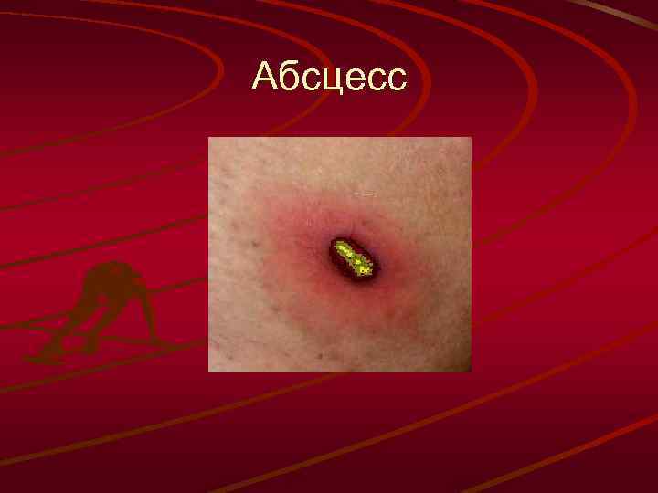 Абсцесс 