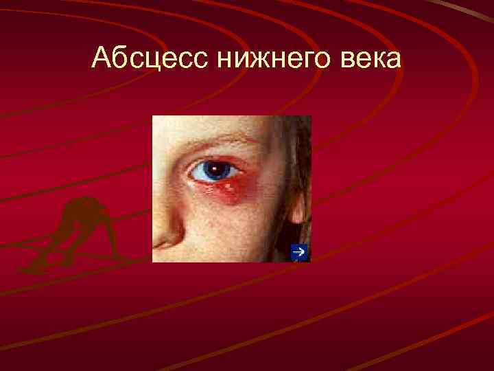 Абсцесс нижнего века 