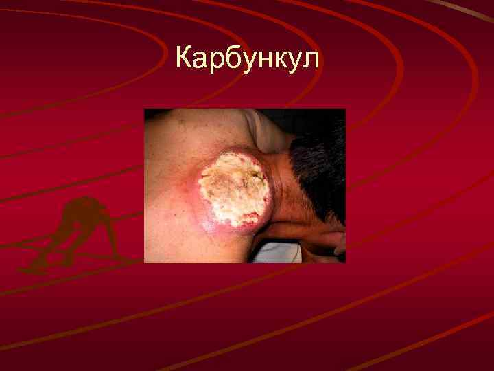 Карбункул 