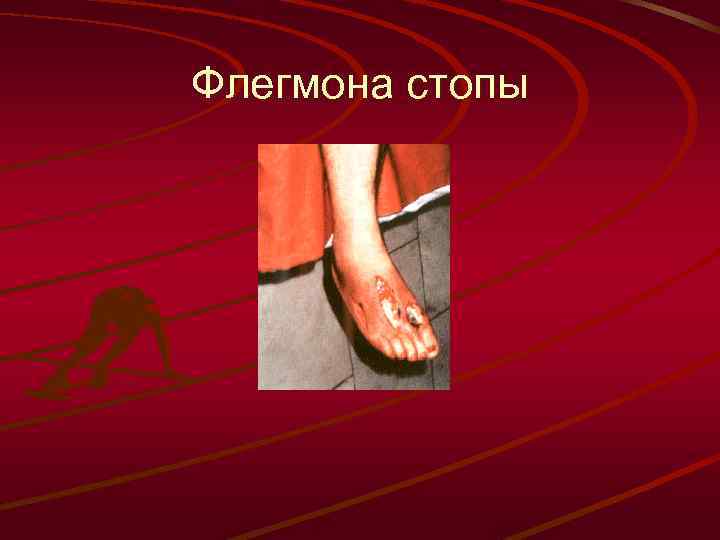 Флегмона стопы 