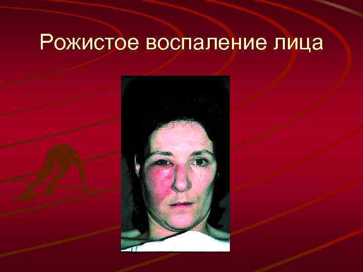 Рожистое воспаление лица 