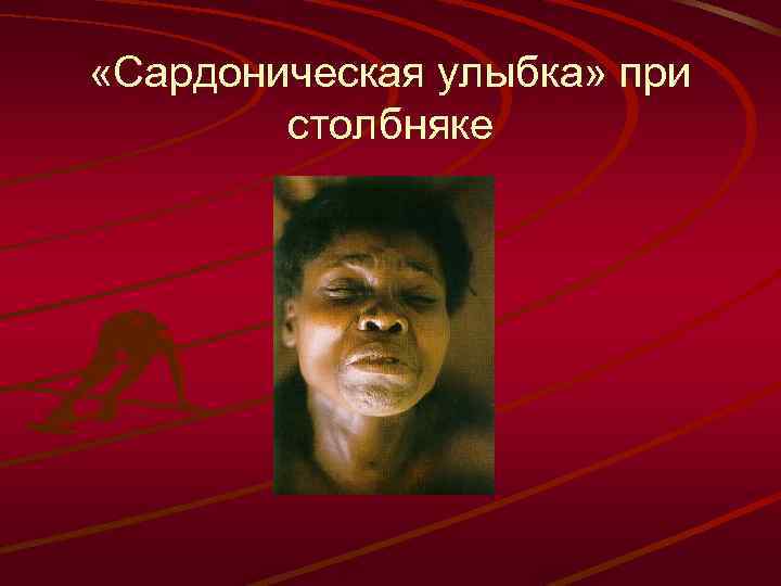  «Сардоническая улыбка» при столбняке 