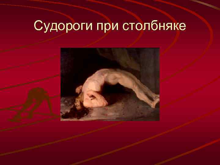 Судороги при столбняке 