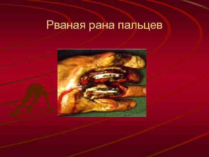 Рваная рана пальцев 