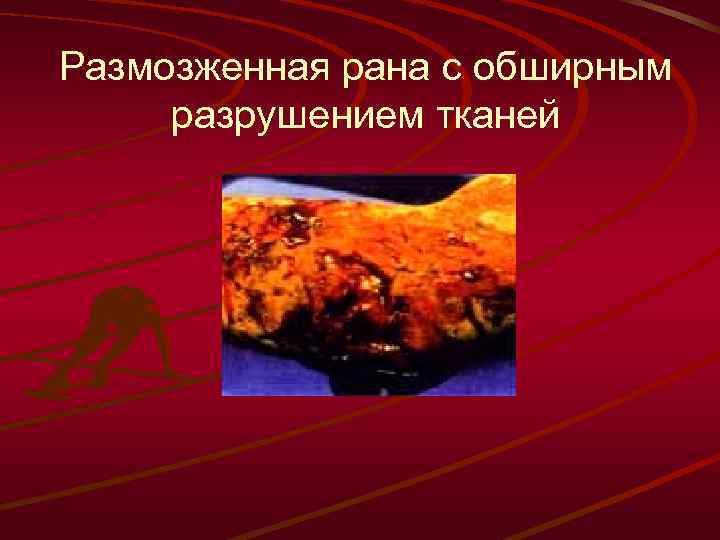 Размозженная рана с обширным разрушением тканей 