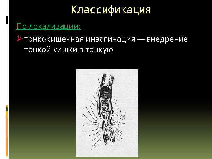 Классификация По локализации: Ø тонкокишечная инвагинация — внедрение тонкой кишки в тонкую 