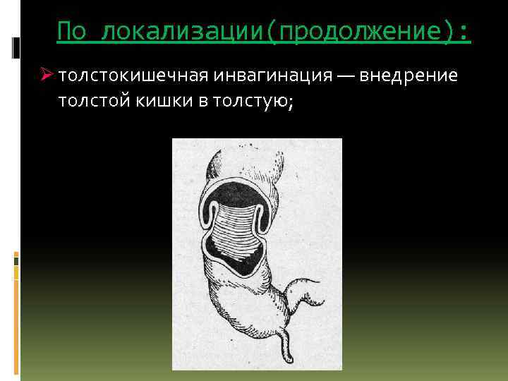 По локализации(продолжение): Ø толстокишечная инвагинация — внедрение толстой кишки в толстую; 