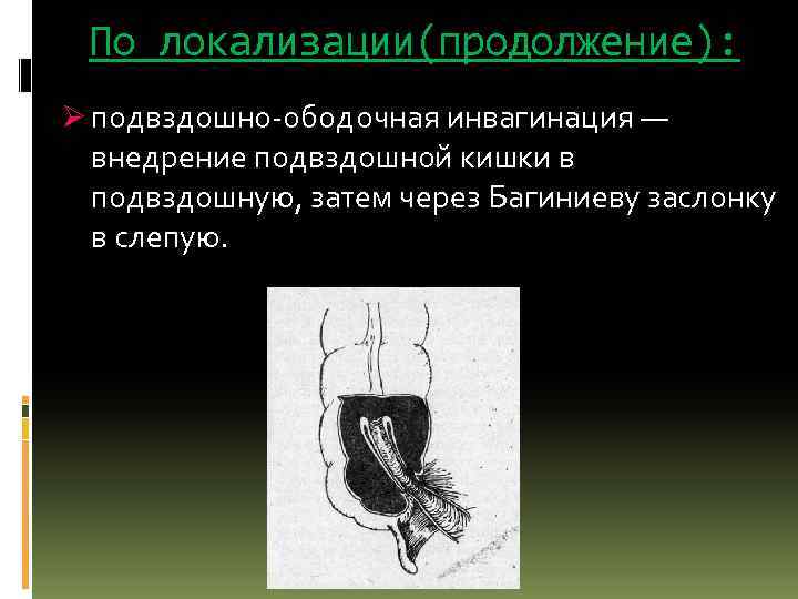 По локализации(продолжение): Ø подвздошно-ободочная инвагинация — внедрение подвздошной кишки в подвздошную, затем через Багиниеву