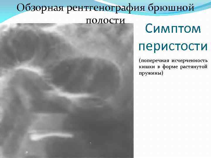 Полость признак. Спаечная кишечная непроходимость рентгенография. Паралитическая кишечная непроходимость рентген. Кишечная непроходимость симптом перистости. Рентген снимки спайки брюшной полости.