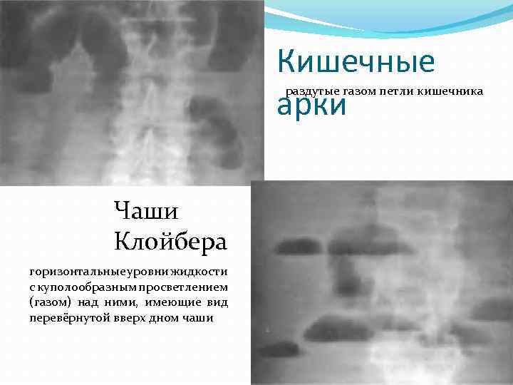 Пневматизация петель кишечника