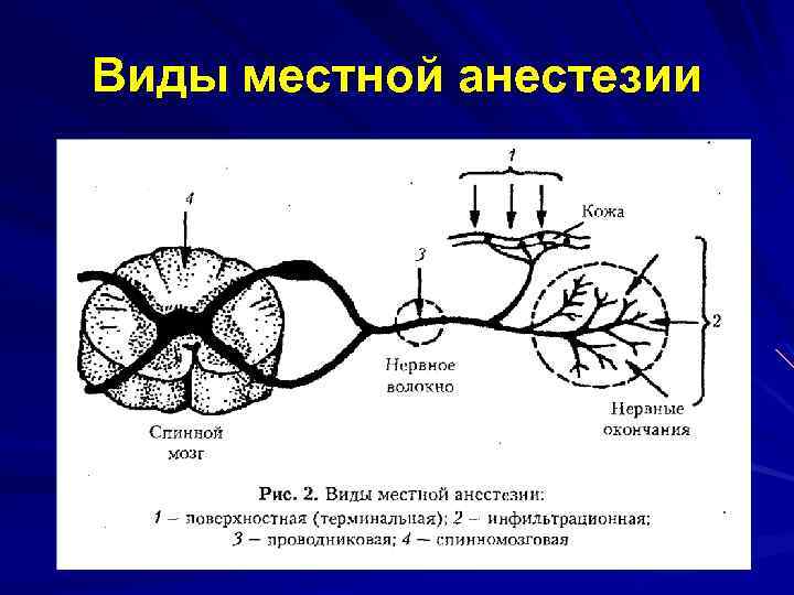 Виды местной анестезии 