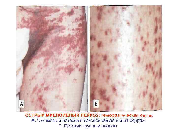 ОСТРЫЙ МИЕЛОИДНЫЙ ЛЕЙКОЗ: геморрагическая сыпь. А. Экхимозы и петехии в паховой области и на