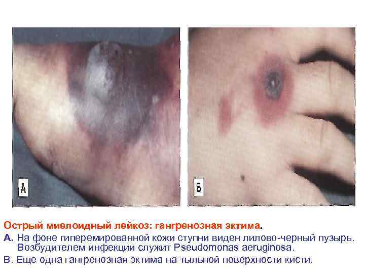 Острый миелоидный лейкоз: гангренозная эктима. А. На фоне гиперемированной кожи ступни виден лилово черный