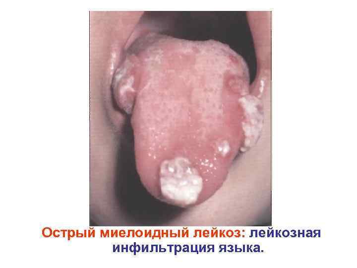Острый миелоидный лейкоз: лейкозная инфильтрация языка. 