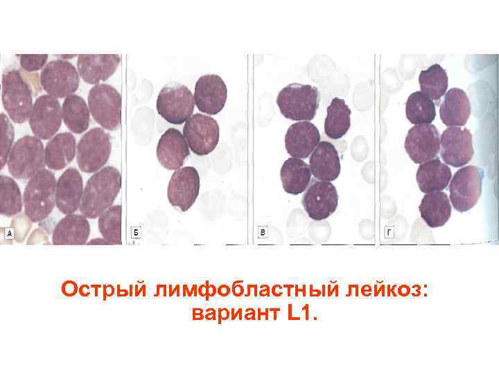 Острый лимфобластный лейкоз: вариант L 1. 