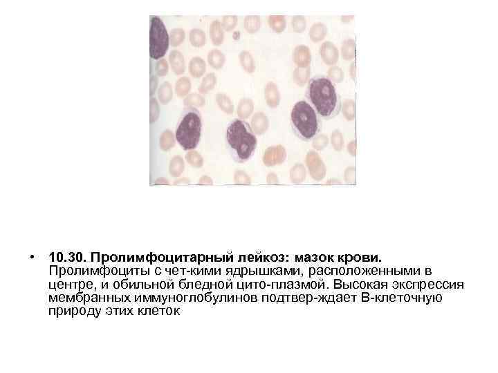  • 10. 30. Пролимфоцитарный лейкоз: мазок крови. Пролимфоциты с чет кими ядрышками, расположенными