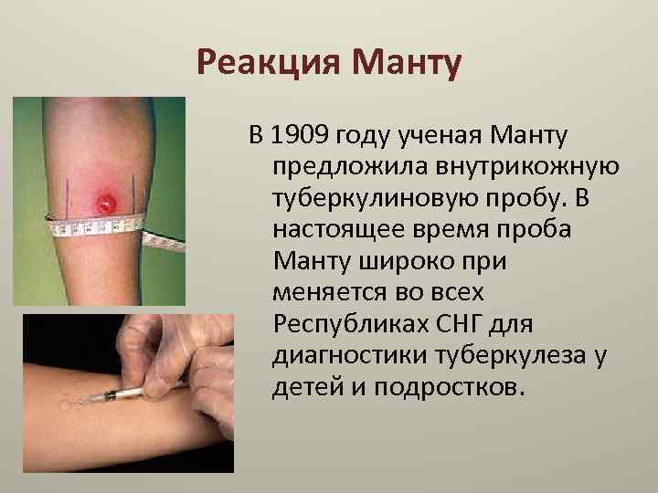 Реакция Манту В 1909 году ученая Манту предложила внутрикожную туберкулиновую пробу. В настоящее время