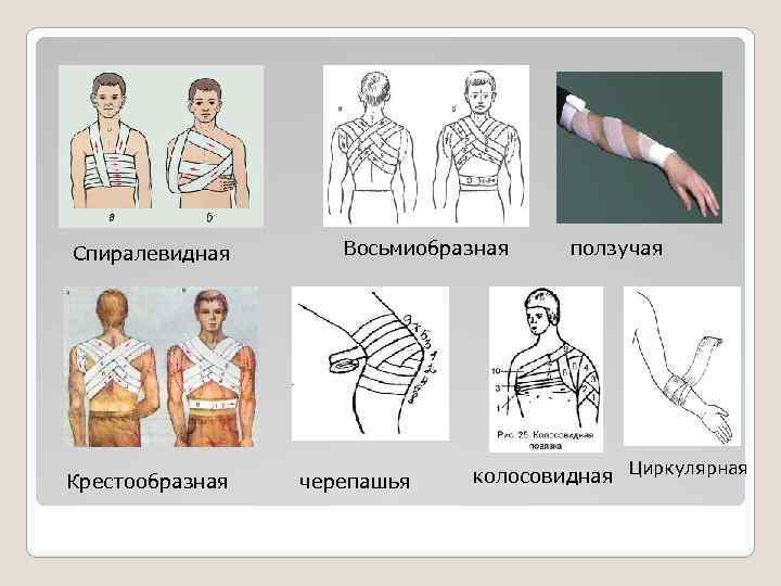 Виды наложения. Виды перевязок названия. Колосовидная повязка (разновидность восьмиобразной повязки. Типы повязок ОБЖ. Виды бинтовых повязок.