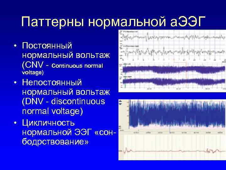 Паттерны нормальной а. ЭЭГ • Постоянный нормальный вольтаж (CNV - Continuous normal voltage) •