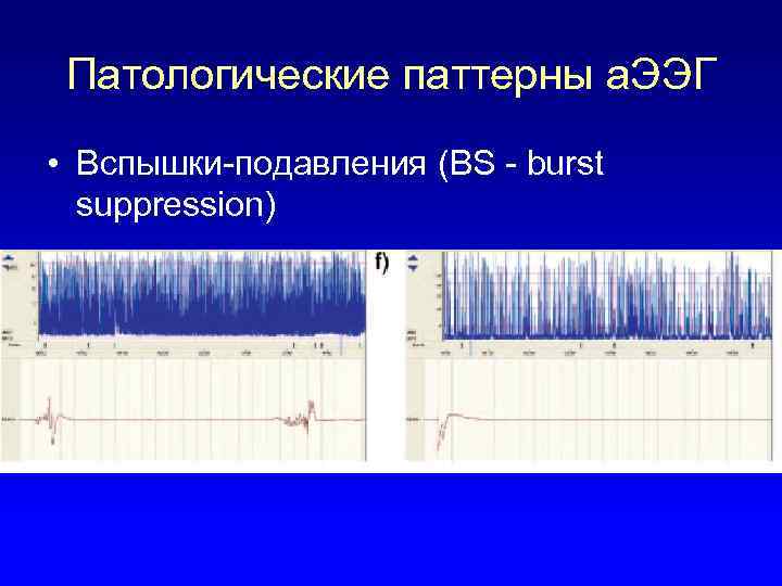 Патологический паттерн. Паттерн вспышка подавление ЭЭГ. Паттерн вспышка подавление характерен для. Патологические паттерны. Гипсаритмии.