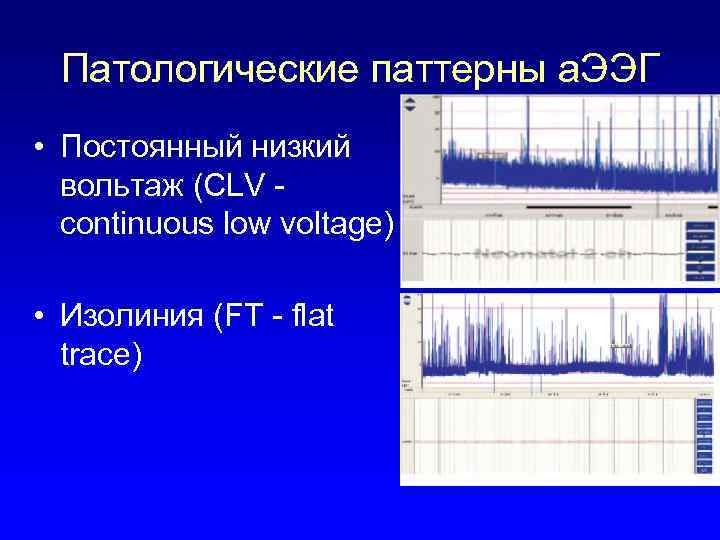 Патологические паттерны а. ЭЭГ • Постоянный низкий вольтаж (CLV continuous low voltage) • Изолиния