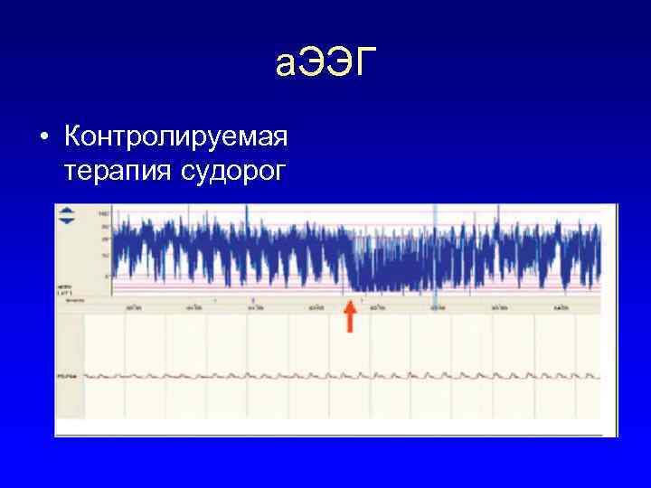 а. ЭЭГ • Контролируемая терапия судорог 