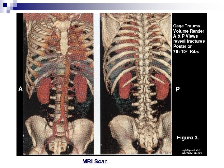 MRI Scan 