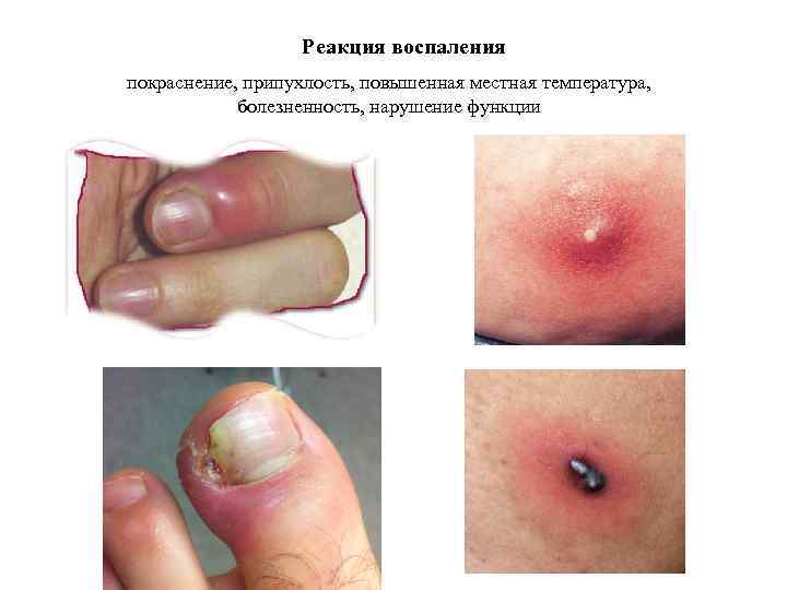 Реакция воспаления покраснение, припухлость, повышенная местная температура, болезненность, нарушение функции 