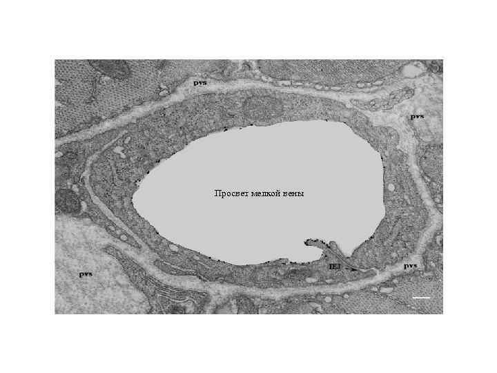 Просвет мелкой вены 