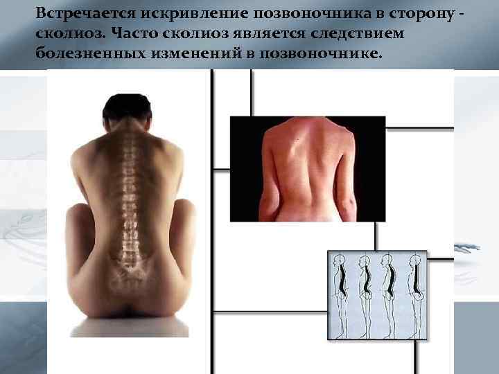 Встречается искривление позвоночника в сторону сколиоз. Часто сколиоз является следствием болезненных изменений в позвоночнике.