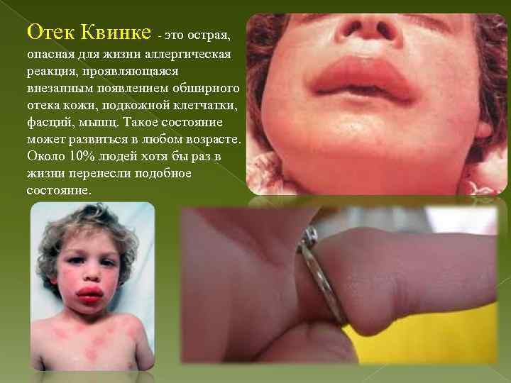 Отек Квинке - это острая, опасная для жизни аллергическая реакция, проявляющаяся внезапным появлением обширного