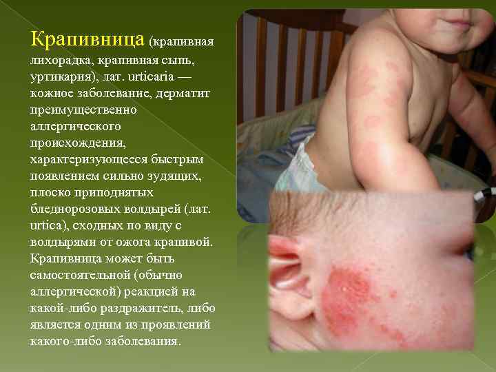 Крапивница (крапивная лихорадка, крапивная сыпь, уртикария), лат. urticaria — кожное заболевание, дерматит преимущественно аллергического