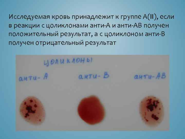 Исследуемая кровь принадлежит к группе А(II), если в реакции с цоликлонами анти АВ получен