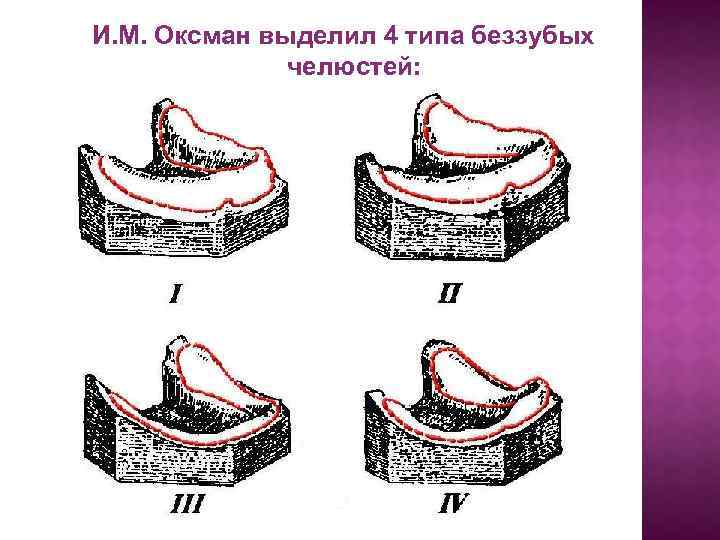 И. М. Оксман выделил 4 типа беззубых челюстей: 