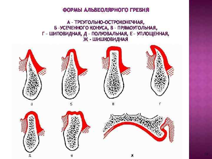 ФОРМЫ АЛЬВЕОЛЯРНОГО ГРЕБНЯ А – ТРЕУГОЛЬНО-ОСТРОКОНЕЧНАЯ, Б –УСЕЧЕННОГО КОНУСА, В – ПРЯМОУГОЛЬНАЯ, Г –