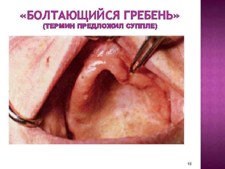  «БОЛТАЮЩИЙСЯ ГРЕБЕНЬ» (ТЕРМИН ПРЕДЛОЖИЛ СУППЛЕ) 18 