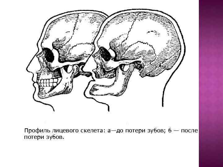 а б Профиль лицевого скелета: а—до потери зубов; б — после потери зубов. 