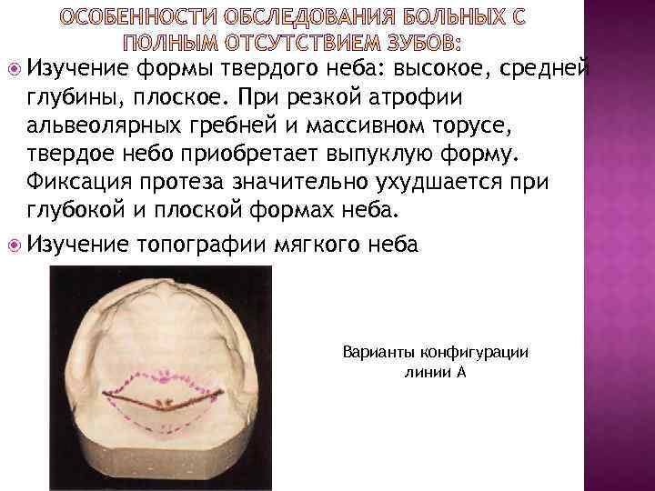  Изучение формы твердого неба: высокое, средней глубины, плоское. При резкой атрофии альвеолярных гребней