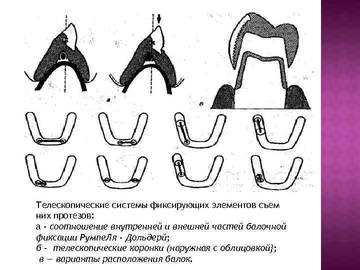 Телескопические системы фиксирующих элементов съем них протезов: а - соотношение внутренней и внешней частей