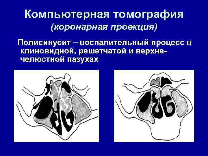 Компьютерная томография (коронарная проекция) Полисинусит – воспалительный процесс в клиновидной, решетчатой и верхнечелюстной пазухах