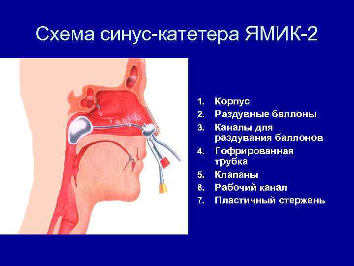 Схема синус-катетера ЯМИК-2 1. 2. 3. 4. 5. 6. 7. Корпус Раздувные баллоны Каналы