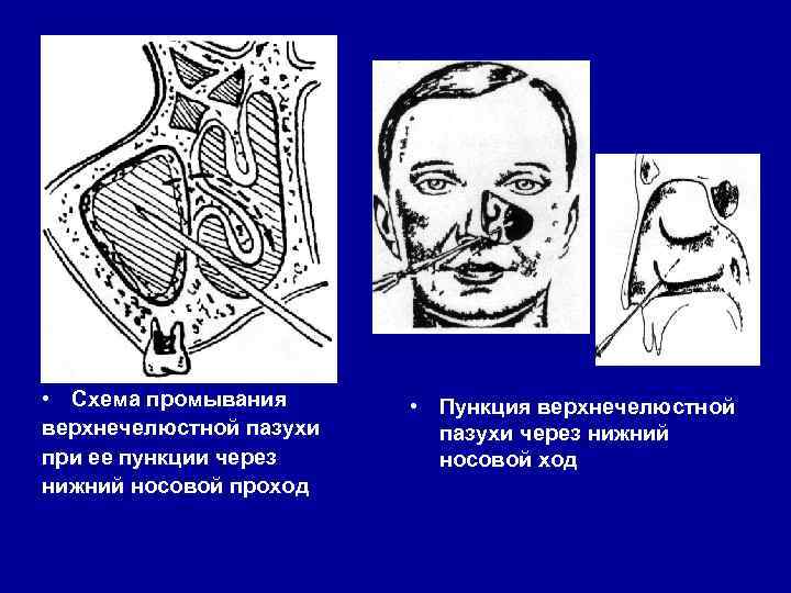  • Схема промывания верхнечелюстной пазухи при ее пункции через нижний носовой проход •