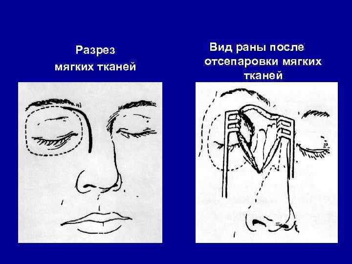 Разрез мягких тканей Вид раны после отсепаровки мягких тканей 