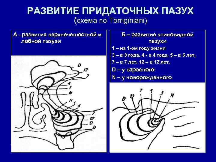 РАЗВИТИЕ ПРИДАТОЧНЫХ ПАЗУХ (схема по Torriginiani) А - развитие верхнечелюстной и лобной пазухи Б