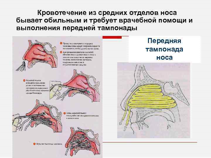 Носовое кровотечение презентация лор