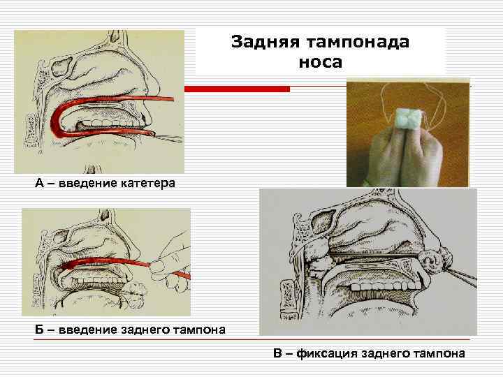 Задняя стенка носоглотки