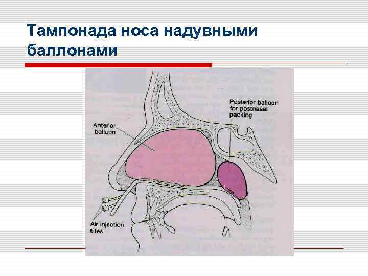 Тампонада носа надувными баллонами 