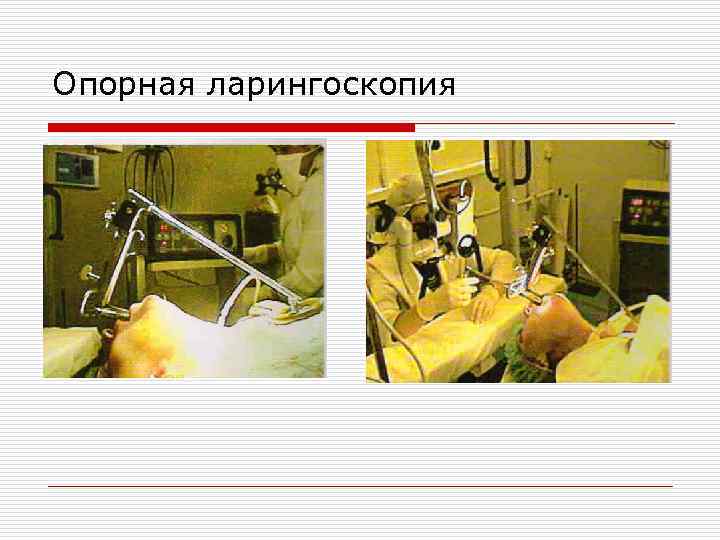 Опорная ларингоскопия 