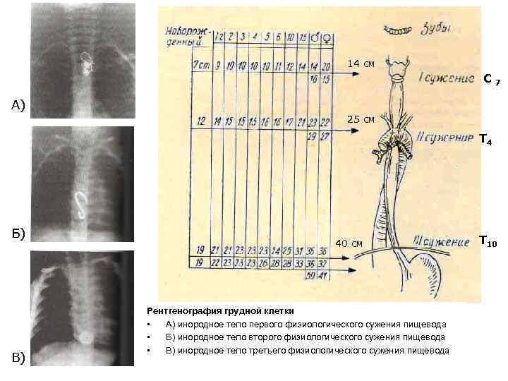 14 см С 7 А) 25 см Т 4 Б) В) 40 см Рентгенография