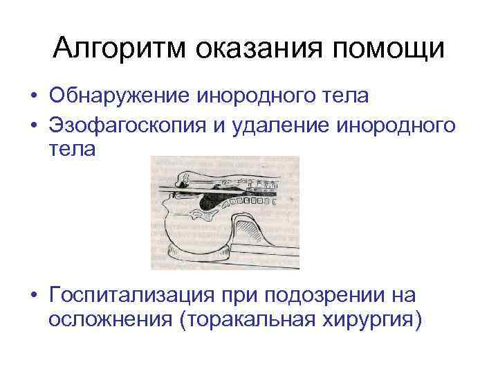 Алгоритм оказания помощи • Обнаружение инородного тела • Эзофагоскопия и удаление инородного тела •